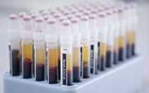 Анализ мочи на лейкоциты: какая норма и что значит повышенный уровень LEU в урине