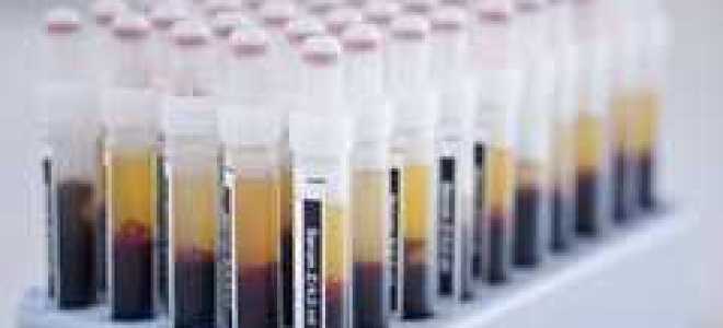 Анализ мочи на лейкоциты: какая норма и что значит повышенный уровень LEU в урине