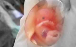 Замершая беременность на 25 неделе