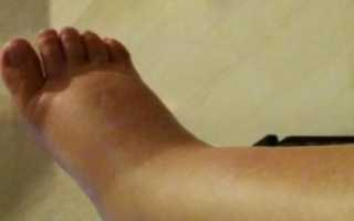 Отекают ноги на 36 неделе беременности