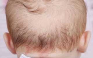 Ребенку 4 месяца выпадают волосы