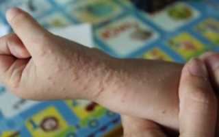 Энтеровирус С Сыпью У Детей Признаки Фото