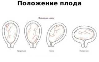 Плод в неустойчивом положении что значит