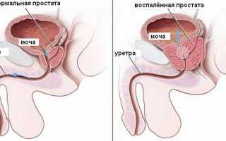 Простатит у мужчин: признаки и первые симптомы
