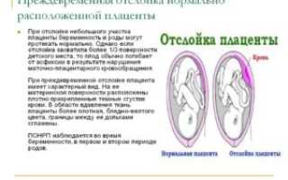 Отслойки плаценты последствия для ребенка