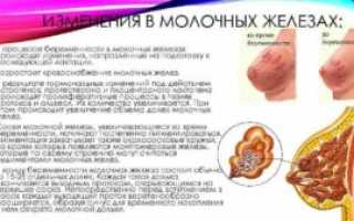 Грудь при внематочной беременности набухает
