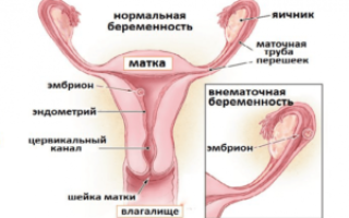 При внематочной беременности матка увеличивается