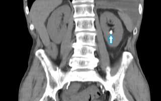 Мочекаменная болезнь. Камни почек и мочеточников, выведение камней из мочеточника, удаление камней из почек.
