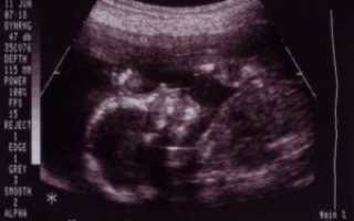 Тонус матки на 26 неделе