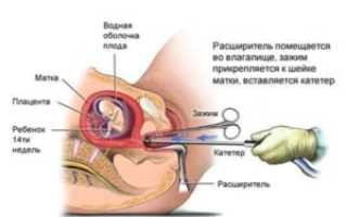 Почему Не Могу Забеременеть После Замершей Беременности