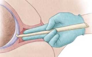 Как размягчить шейку матки на 40 неделе перед родами