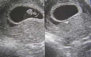 9 Недель и 1 день беременности