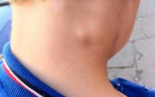 Увеличены Лимфоузлы На Шее У Ребенка Фото