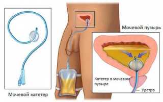 Как самому ввести урологический катетер