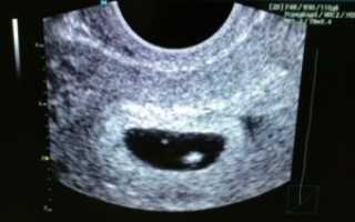 Почему плодное яйцо растет а эмбрион не растет