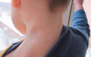 У Ребенка На Шее Сзади Воспалились Лимфоузлы