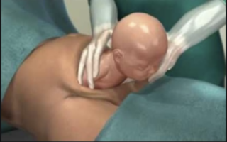 Через какое время после снятия пессария начинаются роды