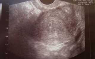 Почему не видно плодное яйцо на узи на ранних сроках беременности