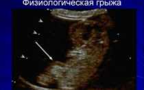 Грыжа плода 12 неделе