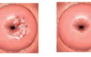 Может ли эрозия шейки матки пройти сама после родов