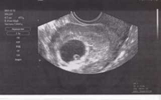 На какой неделе может показать узи беременность