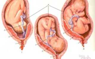 Эмбрион прикрепился к задней стенке матки