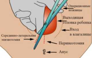 Эпизиоррафия что это при родах