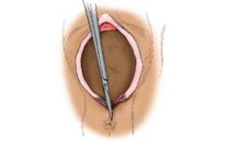 Как выглядит шов после эпизиотомии
