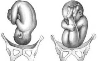 Тазовое предлежание плода в 20 недель беременности