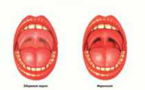Горло Красное У Ребенка Чем Лечить Отзывы