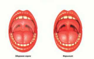 Горло Красное У Ребенка Чем Лечить Отзывы