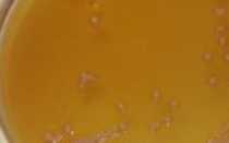 Дрожжи в моче при беременности