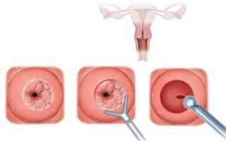 Биопсия шейки матки биопсия на ранних сроках беременности