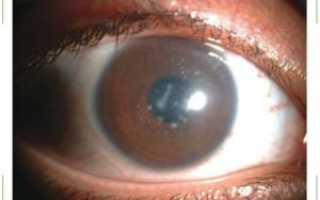 У ребенка пленка на глазу