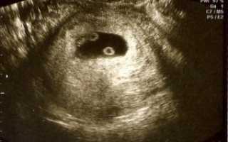 Двойня узи 5 недель беременности фото