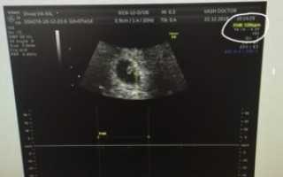 Беременность 7 акушерских недель сердцебиение