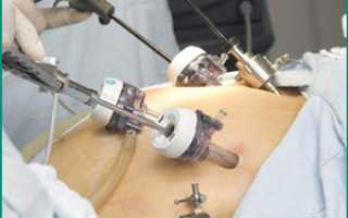 Операция по удалению кисты почки, особенности лапароскопического метода