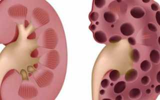 Диета при хронической болезни почек