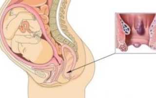 39 Неделя беременности вылез геморрой