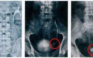 Анализ мочи при камнях в почках