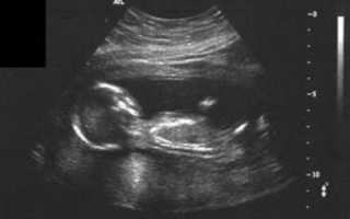 Может ли беременность замереть на 17 неделе