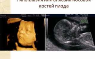 Аплазия носовой кости у плода 12 недель что это значит