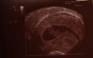 Беременность 6 недель 4 дня