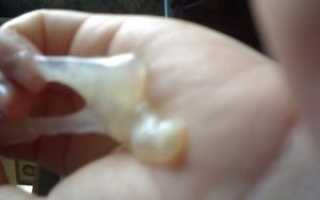 Может ли при пессарии отойти пробка