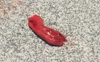 Как выглядят сгустки при выкидыше на раннем сроке фото