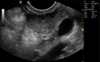 Можно ли миому перепутать с беременностью на узи