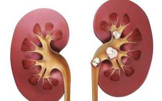 Диета после лапароскопии камней в почках