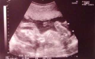 20 Неделя беременности форум