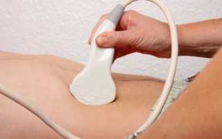 Стентирование мочеточника: показания к проведению процедуры