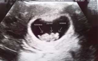 Симптомы Замершей Беременности В Первом Триместре Отзывы